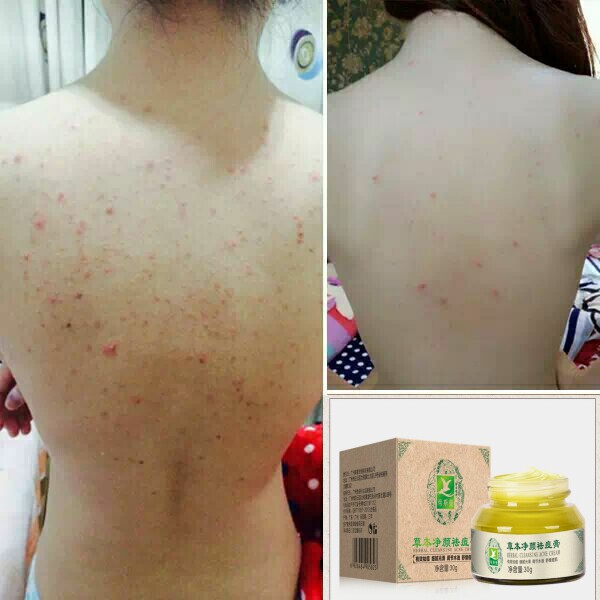 Acne Removal Pimple Pit Repair Acne Closed Mouth Chin Forehead Face Back Acne Male Student Pimple Machine