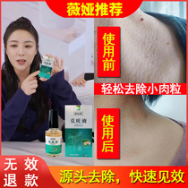 Wart meat a touch of worry-free filamentous filamentous removal especially the neck flat Thorn monkey meat to the wart artifact the hand length of the hand