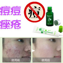 Repair and remove facial blackheads and acne scars remove acne immediately remove back acne and rosacea essence cream