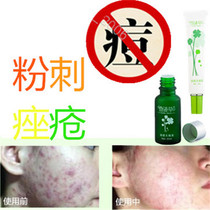 Essence medicinal liquid removes closed acne on the back removes acne and removes pimples on the chest