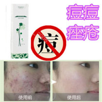 Remove blackheads for men and women closed acne pimples acne scars childrens acne bean repair cream