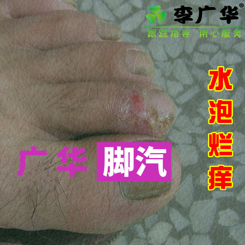 Li Guanghua foot steam spray cream dry row sweat seam ya itch rotten smell peeling foot sweat blisters 9 years old shop good