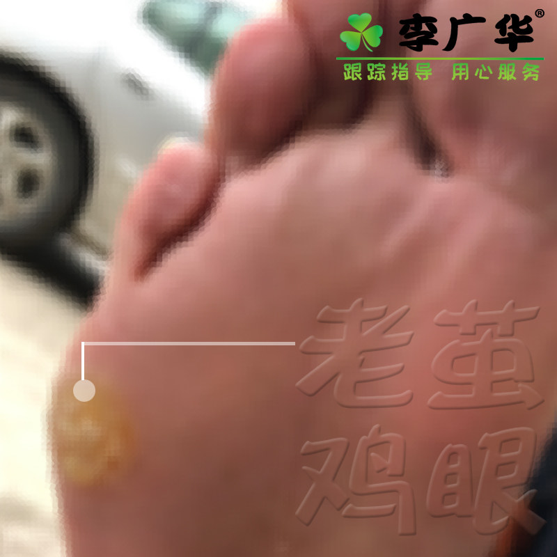 Cocoon removal of hands and feet corns Cocoon softener special artifact heel palm hard cocoon foot pad Li Guanghua good