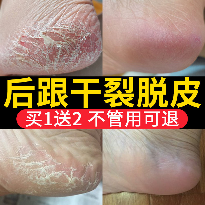 Heel dry cracked hands and feet cracked off skin dry peeling non-repair cream foot sole cream cracked dead skin non-go