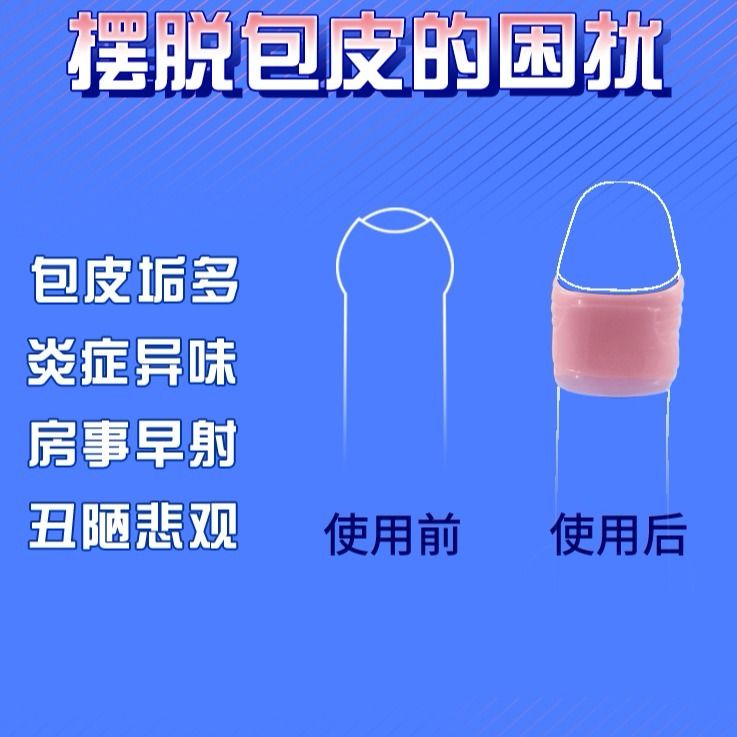 Nemesis-removing foreskin phimosis Japanese silicone anti-removal male blocker ring orthosis foreskin is too long trumpet sex