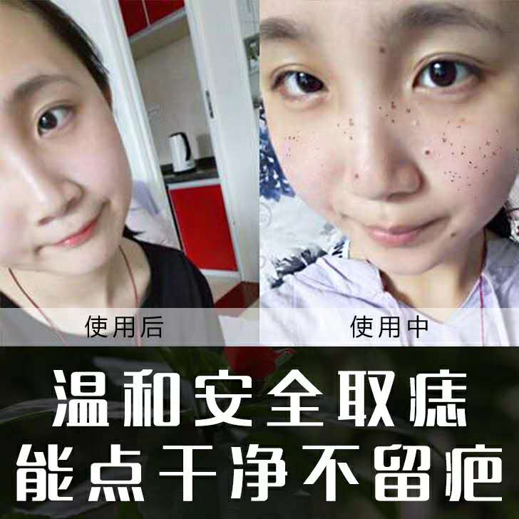 祛 痣 套 装 旗 碱 店