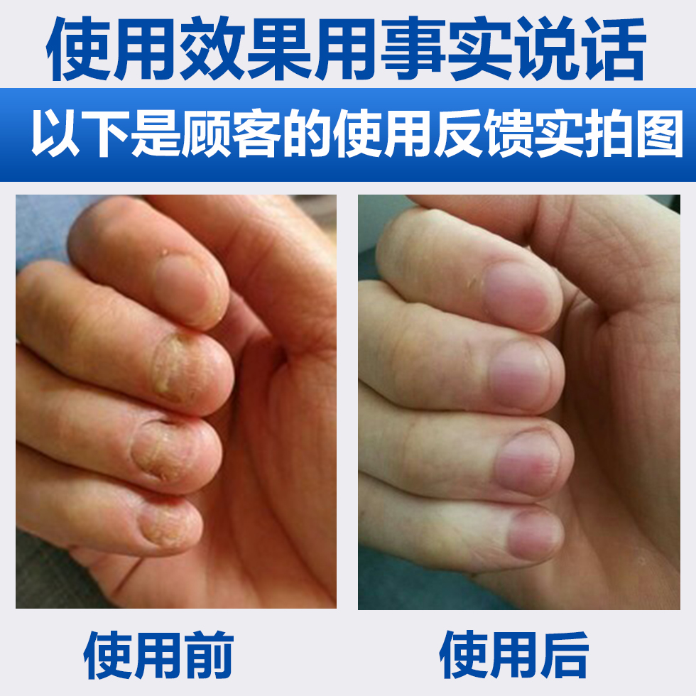 迈瑞普 灰指甲专用液 图2