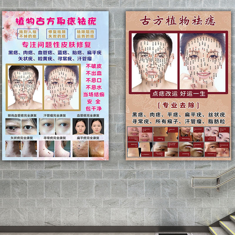 Men and women Facial Mole Tussle Facial Mole Tussle MOLE Mole Spot Cosmetic Yard Decoration Painting Advertisement Open Delivery Plastic Wall Stickup Poster