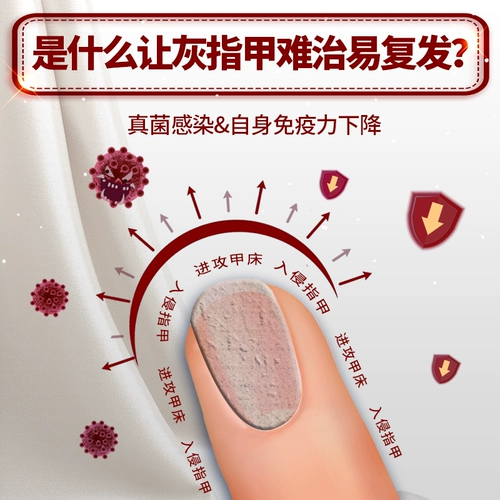 亮甲 Метка xiaohong onychomycosis специальное лекарственное соединение йод йод йод йод лотте -гит -подлинный флагманский магазин