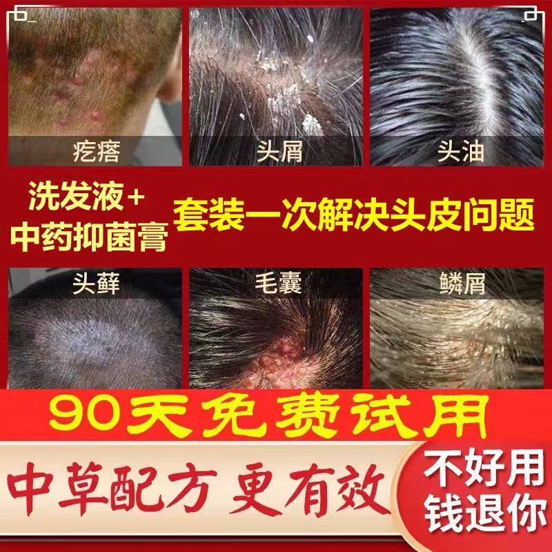 头部头皮痒头屑头痂头螨专用药去痒头皮藓头上长红疙瘩膏真菌感染
