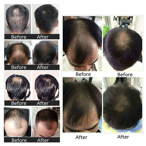 Продукт спреем для роста волос предотвращающий жидкость роста волос с облысением