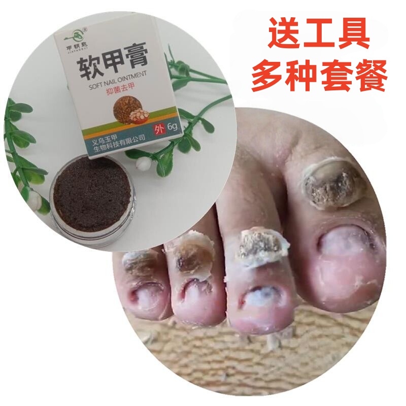 Toe Nail Removal Cream, Soft Nail Cream, Softens Nails, Removes Nails, Nail Removal Essential Oil, Nail Cleanser, Removes Thickening, Discoloration, Kills Fungi Toe Nail Removal Cream, Soft Nail Cream, Softens Nails, Removes Nails, Nail Removal Essential Oil, Nail Cleanser, Removes Thickening, Discoloration, Kills Fungi