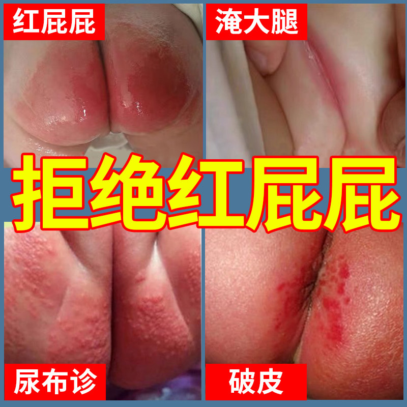 Neonatal Butter Cream Baby Red Butter Music Baby Special artifact Infant Red Broken Butter Skin Butter Cream