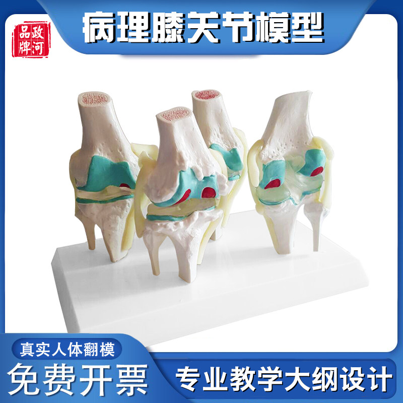 膝关节-理病变模型关节骨质-病态展示人体膝关节模型带图文说明