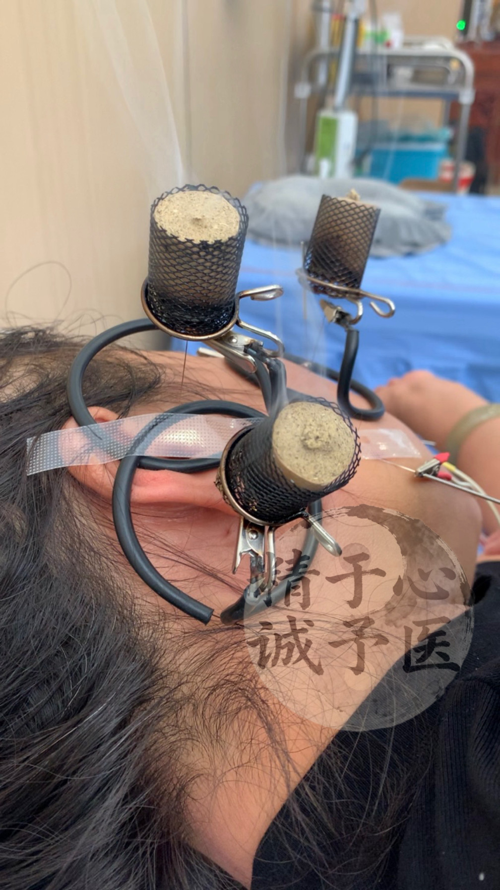 温针灸防落灰器温针灸无烟艾灸器温针灸针灸器温针灸防烫工具艾灸