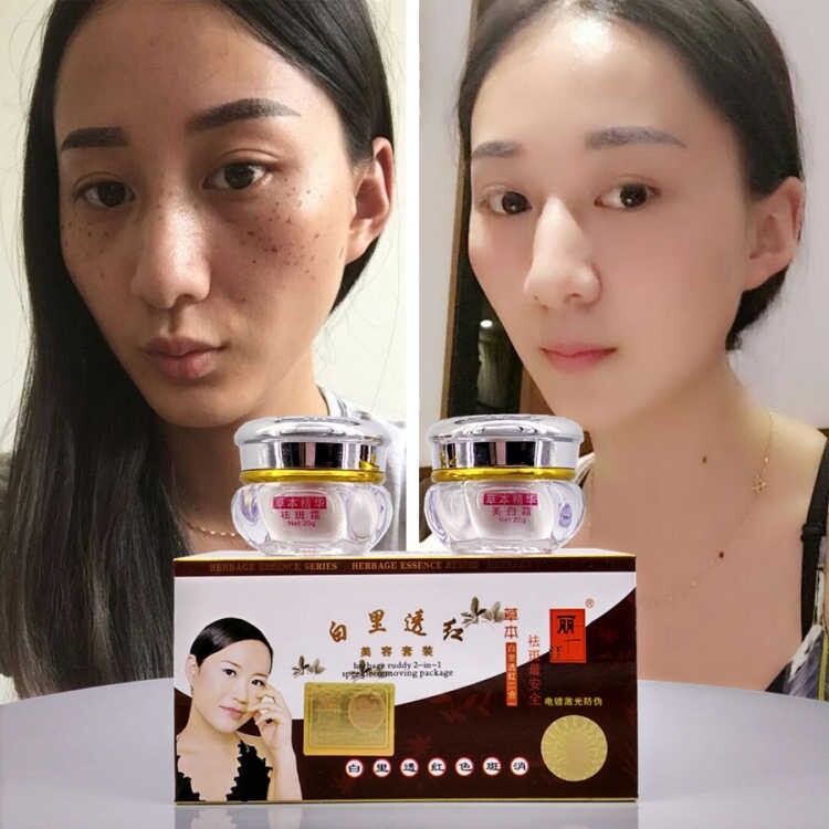 White white white white white freckle to spoil colored patch brown freckles old age to melanin