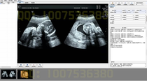 B超彩超软件超声影像胃肠镜宫腹腔镜耳鼻喉镜支气管镜膀胱镜软件