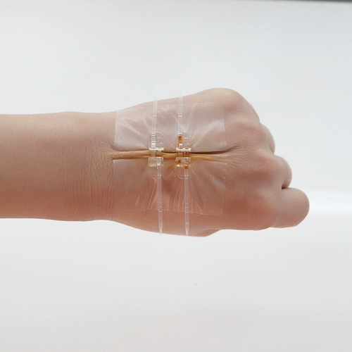 Lingkou Skin Suture Device Medical Extension Reducer Caesarean Sect Scars и операция на щитовидной железе