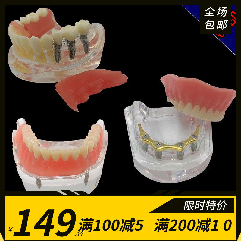 牙科 金杆卡修复模型 种植修复对比模型  种植体解说义齿修复模型