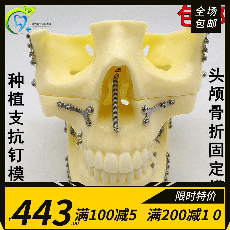 牙科口腔模型 种植支抗钉模型 可拆分头颅骨折固定模型 种植练习