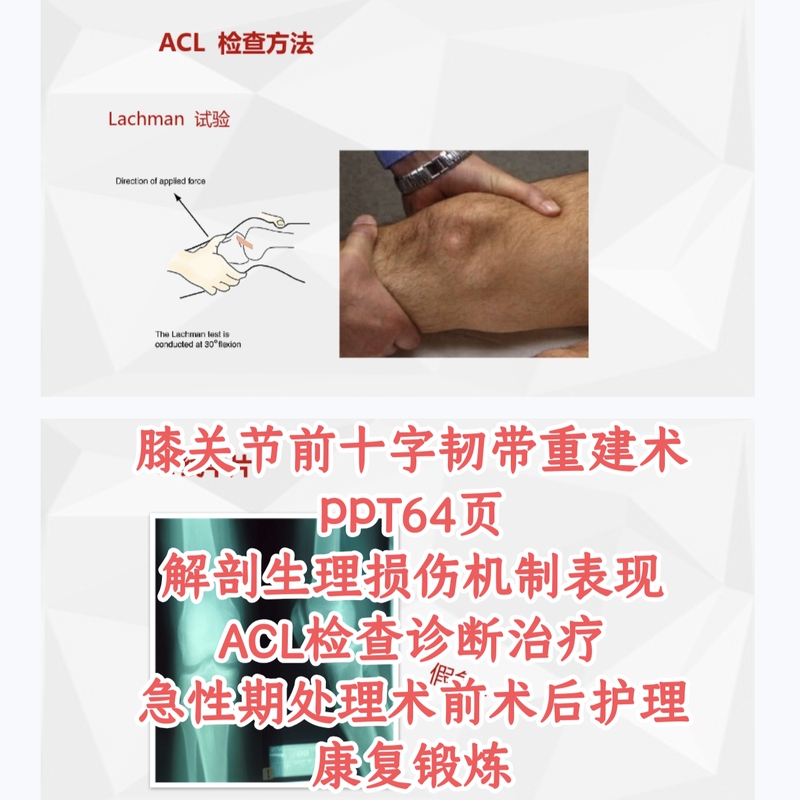 Knee Joint Anterior Cruciate Ligament Reconstruction Surgery Ppt Rehabilitation Exercises Acl Examination Injury Pre- and Post-Surgery Care Ppt Knee Joint Anterior Cruciate Ligament Reconstruction Surgery Ppt Rehabilitation Exercises Acl Examination Injury Pre- and Post-Surgery Care Ppt