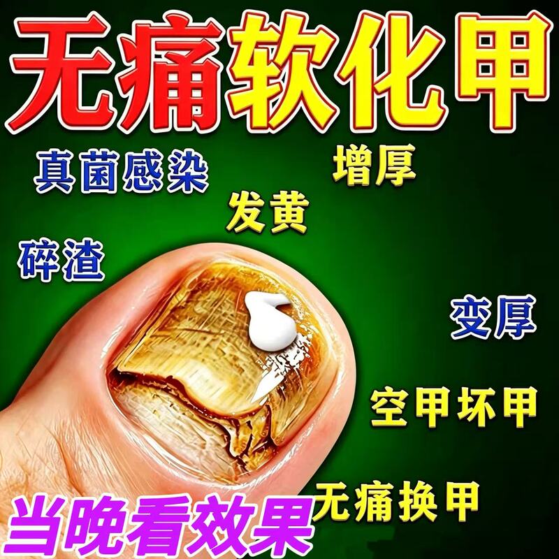 Softening Nail Cream for Onychomycosis, Thickening and Yellowing Toenails, Onychomycosis Treatment, Onychomycosis Softening Cream, Care and Repair Softening Nail Cream for Onychomycosis, Thickening and Yellowing Toenails, Onychomycosis Treatment, Onychomycosis Softening Cream, Care and Repair