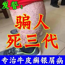 Treatment of psoriasis Psoriasis Skin Ringworm Dermatophyte External Special Effects Medicine Cream To Treat Eczema Stop Itch To Root Hand Foot Stock Moss