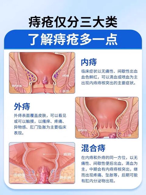 Hemorrhoid Cream for Hemorrhoids, Genuine Product to Remove Flesh Lumps, for Women, Internal and External Hemorrhoids, Cold Compress Gel, Official Genuine Flagship Store