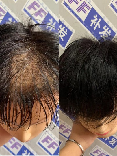 假发维修复加密递针片网底破裂更换头旋生物膜男女式头套发块