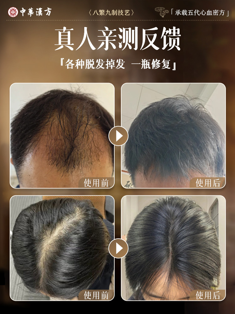 Hair Growth Serum, Hair Growth Agent, Increases Hair Density, Nourishes Hairline, Rapid Growth, Prevents Hair Loss, Nourishing Scalp Essence for Men and Women