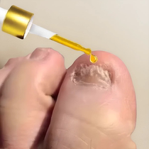 (Tongrentang hot sale) Painless replacement of potassium enjoy a good nail life turn bad nails into good ones drop by drop