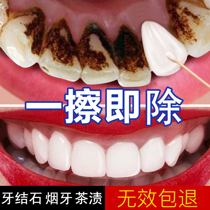 Dental calculus mouthwash calculus remover yellow tartar stains teeth dissolve quick-acting removal artifact removal cleaning