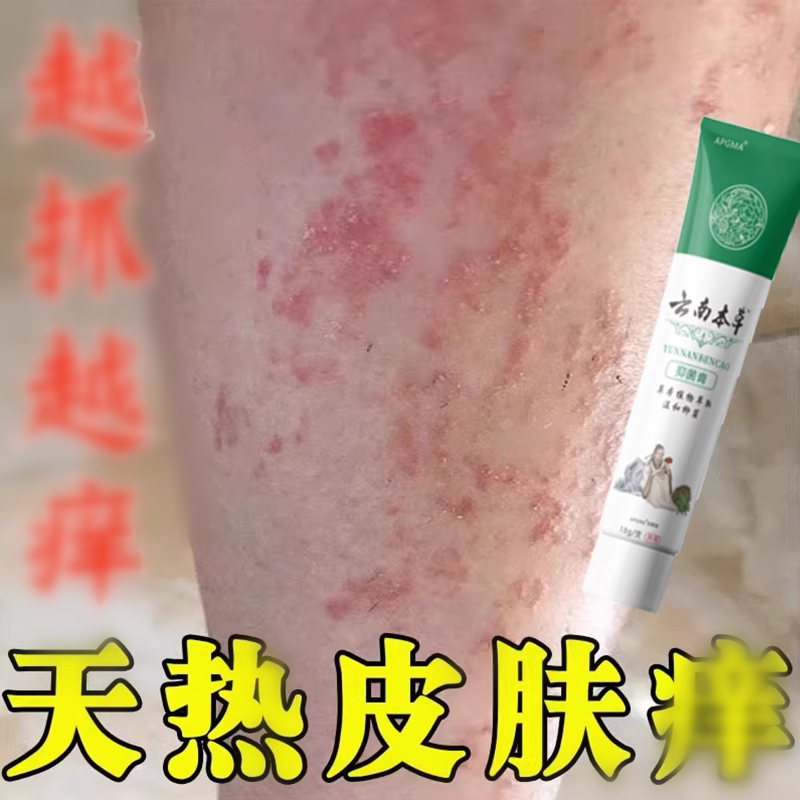Summer Itchy Legs Cream for Adults: Itching from Sweat, Heat Rash, Heat Rash Bumps, and Heat-Related Inflammation Summer Itchy Legs Cream for Adults: Itching from Sweat, Heat Rash, Heat Rash Bumps, and Heat-Related Inflammation