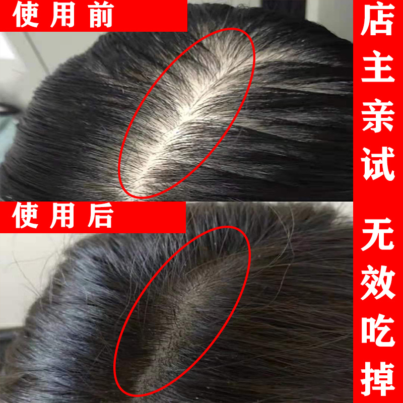 (short I eat) hair natural growth speed male and female hair speed change buy 3 send 2