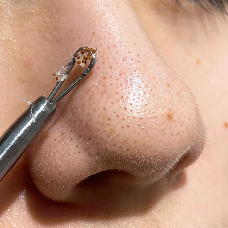 (Weiya live recommendation Buy 2 send 1) L-lactic acid shrink pores fine Chinese liquid ~ Farewell to coarse pores