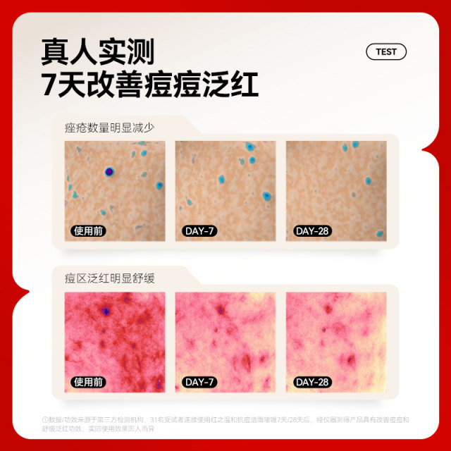 Red Mild Anti-Acne Cleansing Gel ຄ່ອຍໆເຮັດຄວາມສະອາດຮູຂຸມຂົນ, ກໍາຈັດສິວ, ແລະຄວບຄຸມຄວາມມັນແລະບັນເທົາຜິວຫນັງທີ່ລະອຽດອ່ອນ.