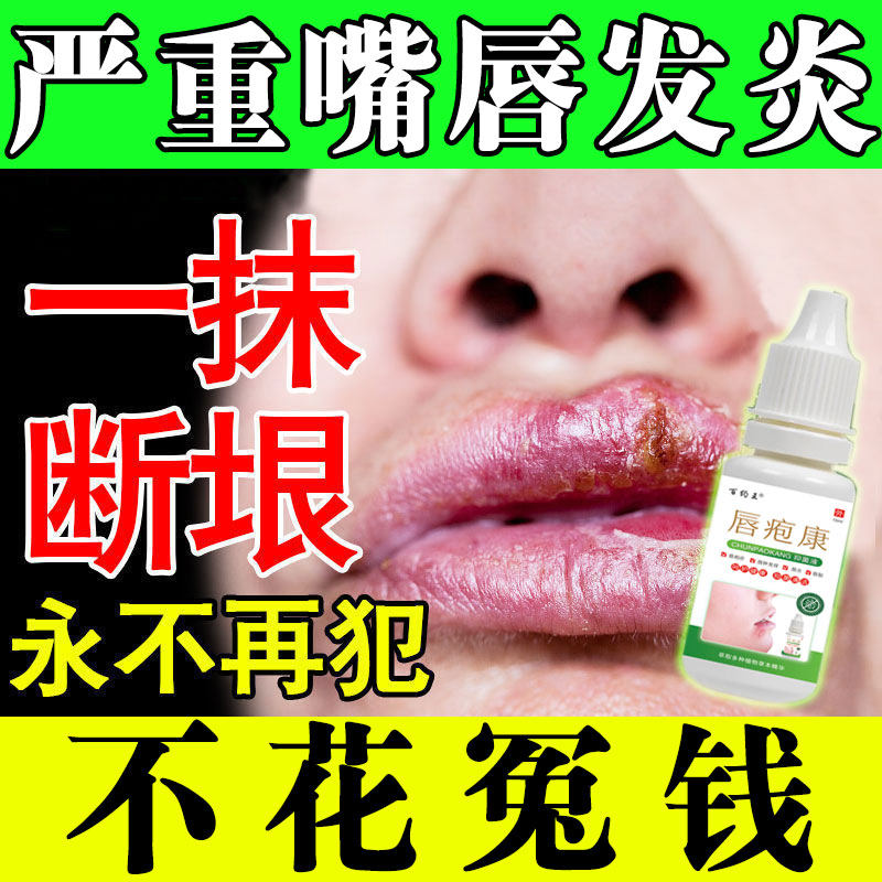 Lips Inflammation Special Ointment Repair God on Fire Dead Leather Mouth Corner Dry Cracked Red Itch nourishing paste Anti-rotten mouth Special medicine