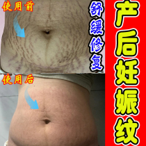 Remove stretch marks fade stretch marks pregnant women postpartum obesity mark protection repair firming and belly scar removal