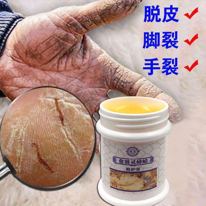 Treatment of cracked feet cream heel cracked dry cracked peeling foot crack dead skin repair old calluses hand cream S