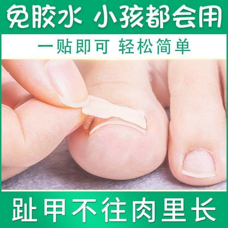 Ingrown Toenail Correction Tool, Ingrown Toenail Corrector, Big Toe Nail Correction Device, No Glue Needed, Pull-On Nail Correction Patch