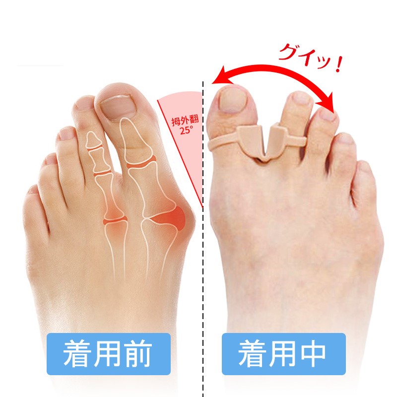 Toe corrector female foot fingerprint large foot bone child thumb outer correction wear shoes