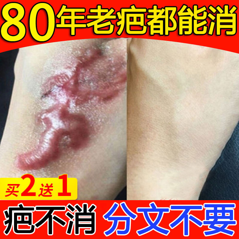 Scar Ba Shi gel in the official website of the rhyme laugh scar net Saba Bawei clear scar flagship store cream 128 scar scar green