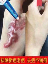 祛 疤膏脸部祛 除贴烫伤手术除疤剖腹产增生修复伤疤儿童专用膏