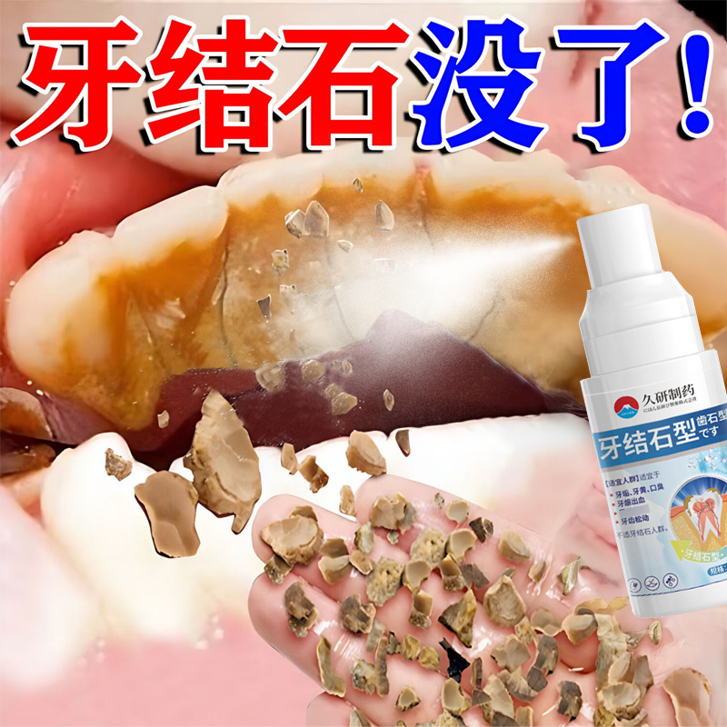 歯石除去剤は歯石を溶かして歯の汚れを素早く落とし、歯を白くし、マウスウォッシュで清潔にします。