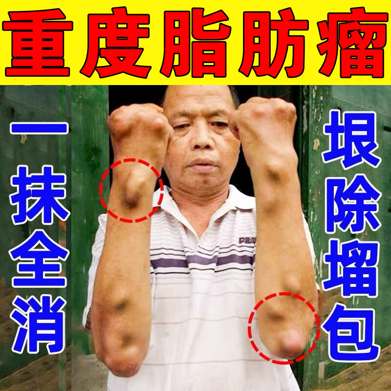 Lipoma removal artifact antitumor paste paste Baikangtang Chinese herbal medicine special to eliminate subcutaneous lumps multiple nemesis