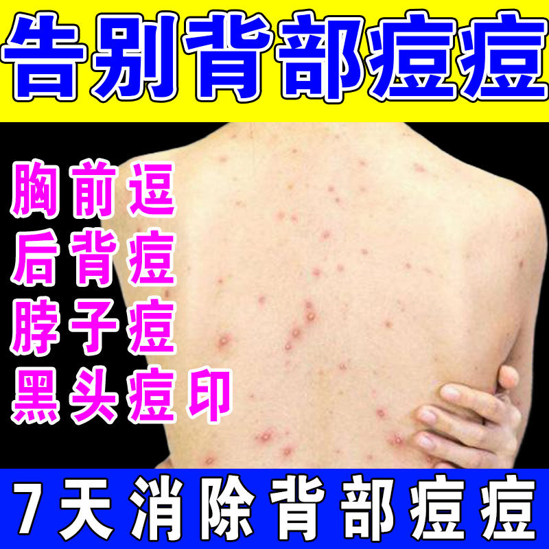 Removing acne prints and blackheads on the back, removing acne on the chest, arms, neck, body and back, removing mites