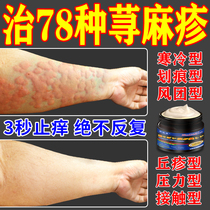 Urticaria allergy antipruritic and root-breaking special medicine chronic and acute wheal papules skin itching imported nemesis ointment