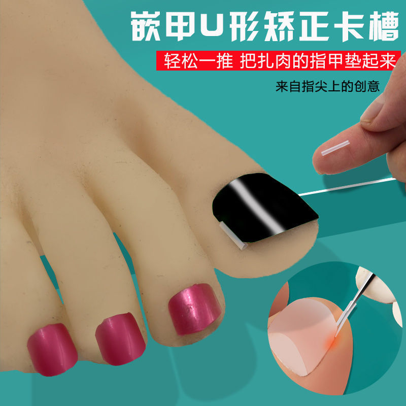 Nail U Shaped Mat Padded with gasket ring sleeve orthodontic armor Padded Correcting Insert Chia Chia Gou nail Nail Knife Pedicure