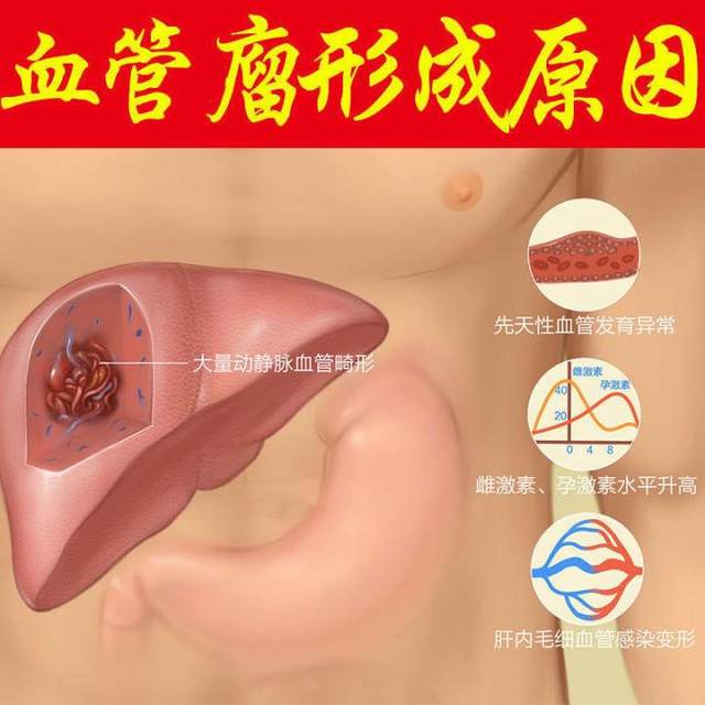 ຊາຕັບ hemangioma ແກ້ cyst ຕັບ, nodules ຕັບແທ້, ascites ຕັບ, ປວດຮາກ, ຮາກ, ໄຂມັນຕັບ, ຢາພື້ນເມືອງຈີນຊາປ້ອງກັນຕັບ