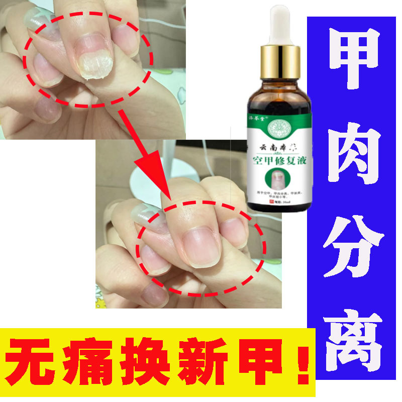 Nail Bed Damage, Short and Cracked Nails, Nail Plate Separation, Nail Bed Damage, Special Repair Solution for Damaged Nails